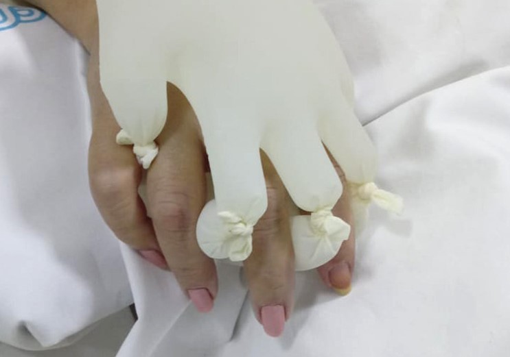 mãozinha, técnica com luvas nas mãos de um paciente